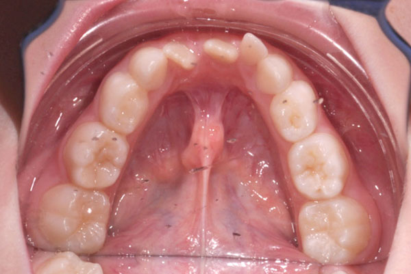 Affollamento severo arcata inferiore