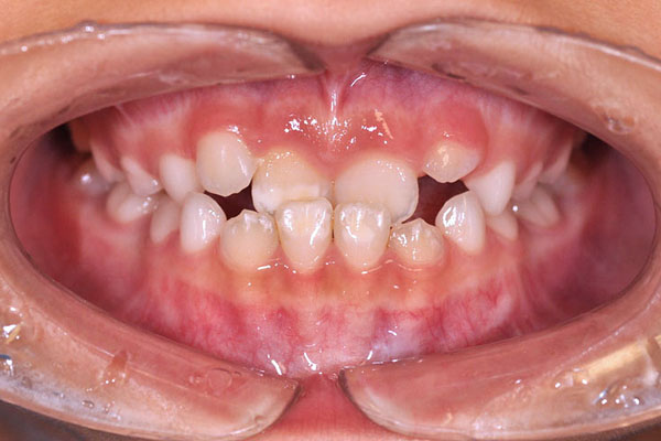 Cross bite dei denti anteriori