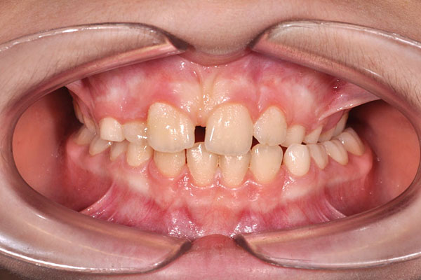Cross bite dei denti posteriori