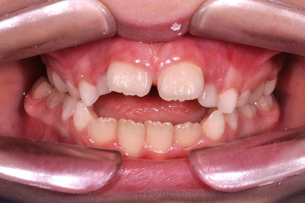 Morso Aperto (Open bite) anteriore