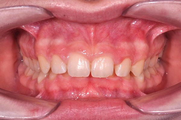 Morso Profondo (Deep bite)