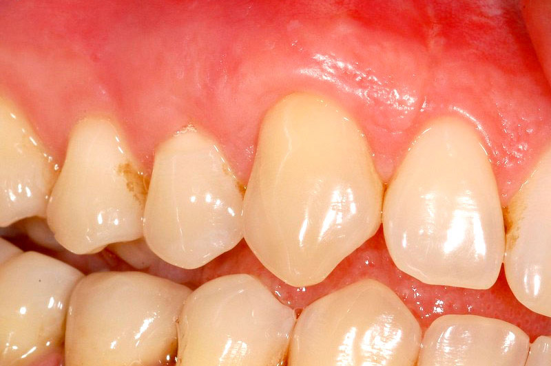Situazione-parodontale-dopo-dell-intervento