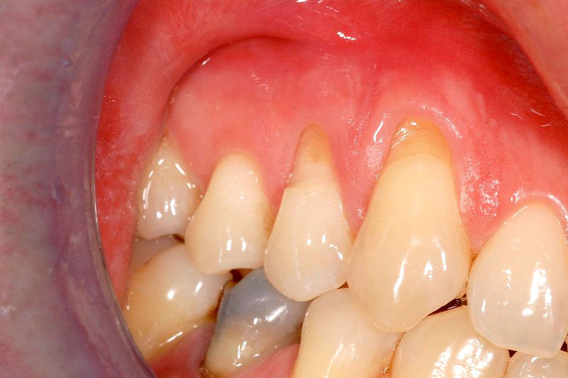Situazione-parodontale-prima-dell-intervento
