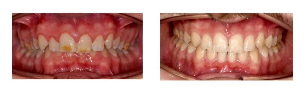 invisalign prima e dopo caso 2 studio pacini mercuri bologna