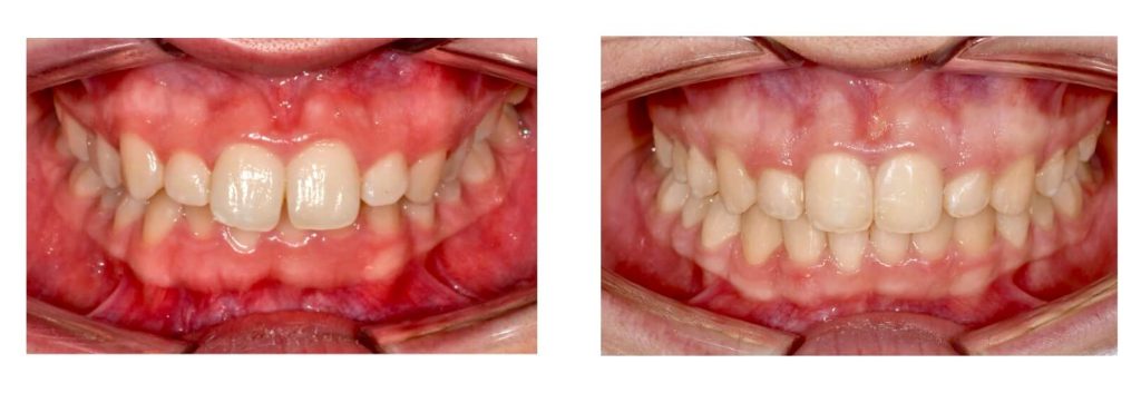 invisalign prima e dopo caso 3 studio pacini mercuri bologna
