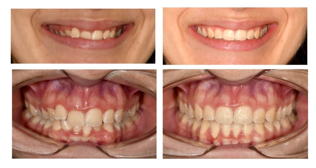 invisalign prima e dopo studio pacini mercuri bologna